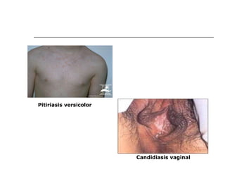 Pitiriasis versicolor Candidiasis vaginal 