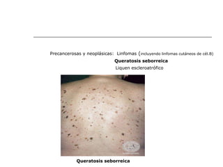 Precancerosas y neoplásicas:  Linfomas  ( incluyendo linfomas cutáneos de cél.B) Queratosis seborreica Liquen escleroatrófico Queratosis seborreica 