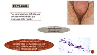 ERITRASMA 
Piel escamosa bien definida con 
parches de color rojizo que 
progresa a color marrón 
Corynebacterium 
minutissimum 
Lesiones muestran una 
característica de fluorescencia rojo 
coral cuando se examina con una 
lámpara de wood 
 