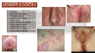 DERMATOLÓGICAS 
• Psoriasis 
• Dermatitis seborreica 
• Dermatitis atópica 
• Dermatitis de contacto 
• Liquen plano 
• Liquen escleroso y atrófico 
• Liquen simple crónico 
• Malignidades locales 
• Enfermedad de Paget 
• Enfermedad de Bowen 
 
