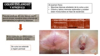 LIQUEN ESCLEROSO 
Y ATRÓFICO 
Pápulas atróficas de color blanco marfil 
que al romper muestran área eritematosa 
intensamente pruriginosa y dolorosa 
Área sustituida por inflamación 
crónica, esclerosis y atrofia 
De vulva se extiende 
a región perineal 
Al examen físico 
• Manchas blancas alrededor de la vulva y ano 
• Clítoris y labios menores aplanados y pueden 
estar involucrados en fase de esclerosis 
• Esteroides tópicos (clobetasol y luego 
hidrocortisona) 
• Si no responde biopsia 
 