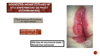 ADENOCARCINOMA CUTÁNEO IN 
SITU (ENFERMEDAD DE PAGET 
EXTRAMAMARIA) 
Placa eritematosa eczematoide 
en región perianal 
Extracción local, que 
puede requerir injerto 
Alta tasa de recurrencia hasta 1 
década tras extracción 
 
