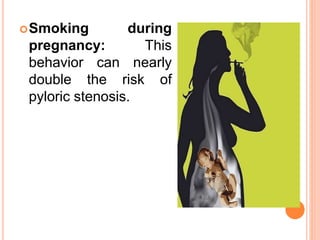 Smoking during
pregnancy: This
behavior can nearly
double the risk of
pyloric stenosis.
 