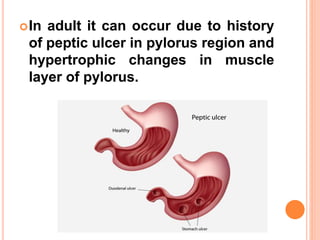 In adult it can occur due to history
of peptic ulcer in pylorus region and
hypertrophic changes in muscle
layer of pylorus.
 