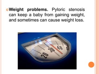 Weight problems. Pyloric stenosis
can keep a baby from gaining weight,
and sometimes can cause weight loss.
 