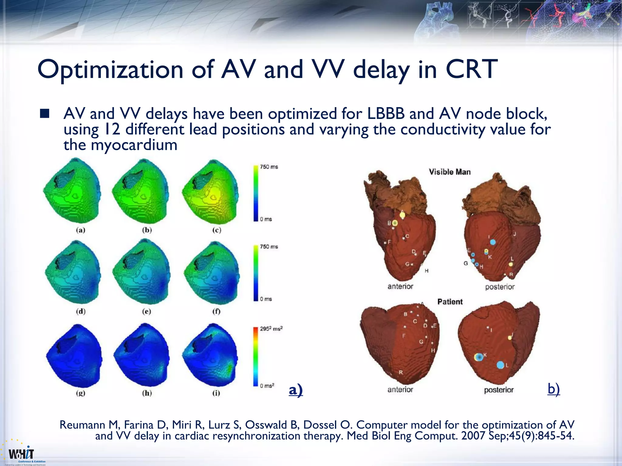 Optimization of AV and VV delay in CRT
 AV and VV delays have been optimized for LBBB and AV node block,
   using 12 different lead positions and varying the conductivity value for
   the myocardium




                                              a)                                               b)

  Reumann M, Farina D, Miri R, Lurz S, Osswald B, Dossel O. Computer model for the optimization of AV
       and VV delay in cardiac resynchronization therapy. Med Biol Eng Comput. 2007 Sep;45(9):845-54.
 