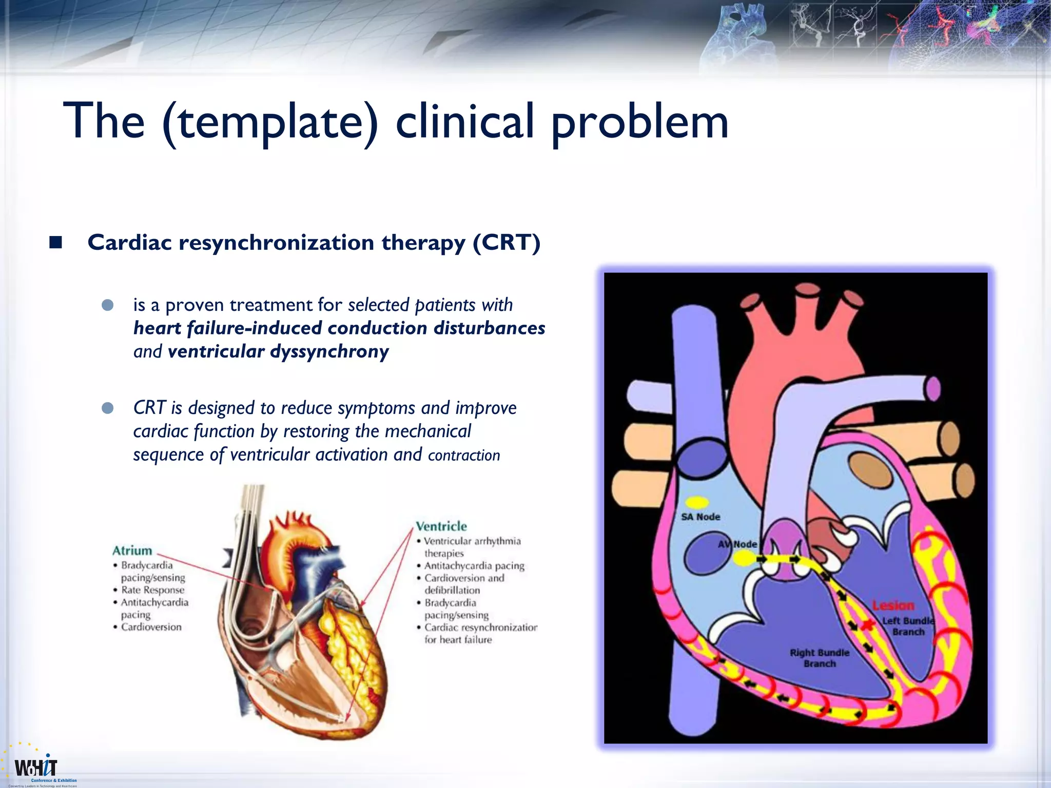 The (template) clinical problem

   Cardiac resynchronization therapy (CRT)

        is a proven treatment for selected patients with
         heart failure-induced conduction disturbances
         and ventricular dyssynchrony

        CRT is designed to reduce symptoms and improve
         cardiac function by restoring the mechanical
         sequence of ventricular activation and contraction
 
