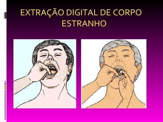 EXTRAÇÃO DIGITAL DE CORPO ESTRANHO 