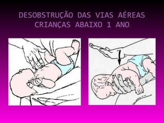DESOBSTRUÇÃO DAS VIAS AÉREAS CRIANÇAS ABAIXO 1 ANO 