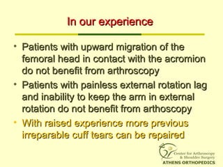 In our experienceIn our experience
• Patients with upward migration of thePatients with upward migration of the
femoral head in contact with the acromionfemoral head in contact with the acromion
do not benefit from arthroscopydo not benefit from arthroscopy
• Patients with painless external rotation lagPatients with painless external rotation lag
and inability to keep the arm in externaland inability to keep the arm in external
rotation do not benefit from arthoscopyrotation do not benefit from arthoscopy
• With raised experience more previousWith raised experience more previous
irreparable cuff tears can be repairedirreparable cuff tears can be repaired
 