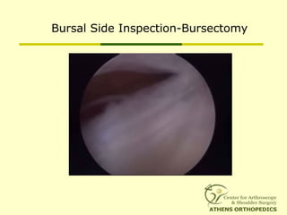 Bursal Side Inspection-Bursectomy
 