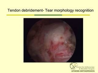 Tendon debridement- Tear morphology recognition
 