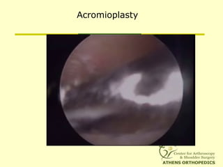 Acromioplasty
 