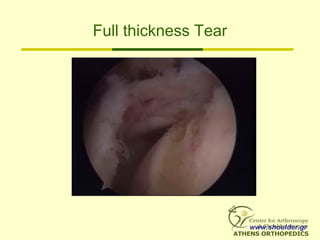 Full thickness Tear
www.shoulder.gr
 