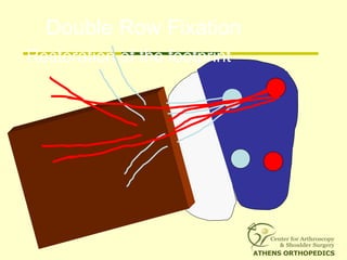 Double Row Fixation
Restoration of the footprint
 