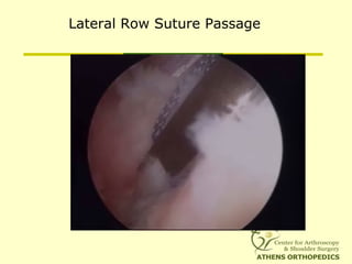 Lateral Row Suture Passage
 