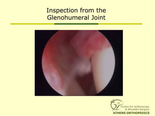 Inspection from the
Glenohumeral Joint
 