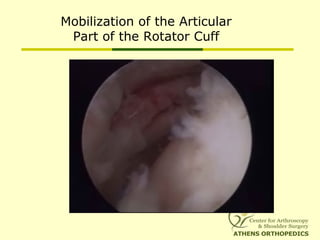 Mobilization of the Articular
Part of the Rotator Cuff
 