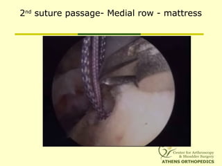 2nd
suture passage- Medial row - mattress
 