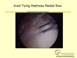 Knot Tying Mattress Medial Row
 