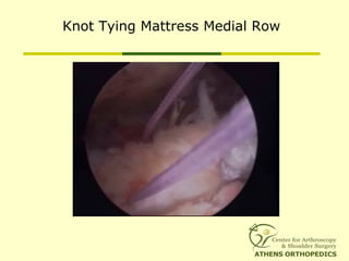 Knot Tying Mattress Medial Row
 