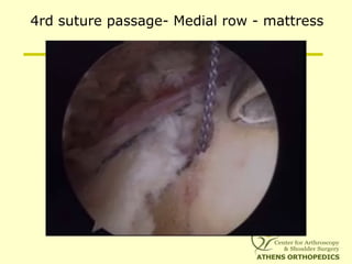 4rd suture passage- Medial row - mattress
 