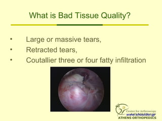 What is Bad Tissue Quality?
• Large or massive tears,
• Retracted tears,
• Coutallier three or four fatty infiltration
www.shoulder.gr
 