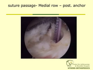 suture passage- Medial row – post. anchor
 