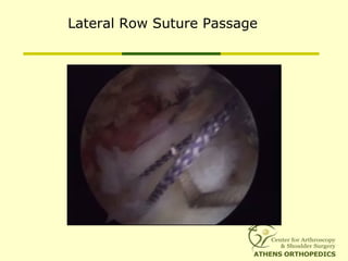 Lateral Row Suture Passage
 