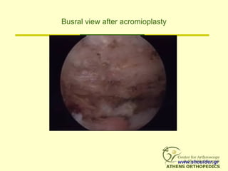 Busral view after acromioplasty
www.shoulder.gr
 