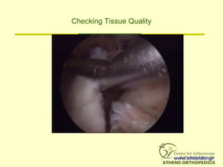 Checking Tissue Quality
www.shoulder.gr
 