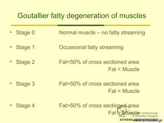 Goutallier fatty degeneration of muscles
• Stage 0 Normal muscle – no fatty streaming
• Stage 1 Occasional fatty streaming
• Stage 2 Fat<50% of cross sectioned area
Fat < Muscle
• Stage 3 Fat=50% of cross sectioned area
Fat = Muscle
• Stage 4 Fat>50% of cross sectioned area
Fat > Muscle
www.shoulder.gr
 