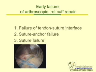 Early failure
of arthroscopic rot cuff repair
1. Failure of tendon-suture interface
2. Suture-anchor failure
3. Suture failure
www.shoulder.gr
 