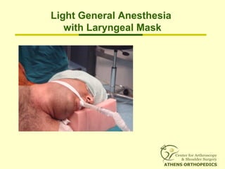 Light General Anesthesia
with Laryngeal Mask
 