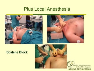 Plus Local Anesthesia
Scalene Block
 