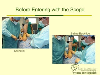 Before Entering with the Scope
Saline Backflow
Saline in
 