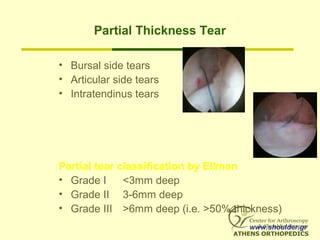 Partial Thickness Tear
• Bursal side tears
• Articular side tears
• Intratendinus tears
Partial tear classification by Ellman
• Grade I <3mm deep
• Grade II 3-6mm deep
• Grade III >6mm deep (i.e. >50% thickness)
www.shoulder.gr
 