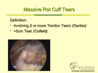 Massive Rot Cuff TearsMassive Rot Cuff Tears
Definition:Definition:
• Involving 2 or more Tendon TearsInvolving 2 or more Tendon Tears (Gerber)(Gerber)
• >5cm Tear>5cm Tear (Cofield)(Cofield)
 