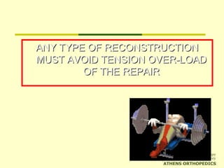 ANY TYPE OF RECONSTRUCTIONANY TYPE OF RECONSTRUCTION
MUST AVOID TENSION OVER-LOADMUST AVOID TENSION OVER-LOAD
OF THE REPAIROF THE REPAIR
 