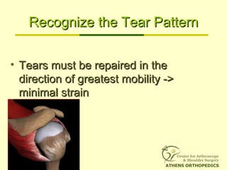 Recognize the Tear PatternRecognize the Tear Pattern
• Tears must be repaired in theTears must be repaired in the
direction of greatest mobility ->direction of greatest mobility ->
minimal strainminimal strain
 
