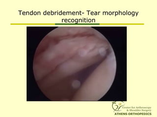 Tendon debridement- Tear morphology
recognition
 