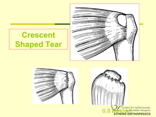 Crescent
Shaped Tear
S.S Burkhart
 