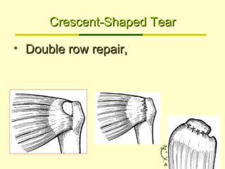 Crescent-Shaped TearCrescent-Shaped Tear
• Double row repair,Double row repair,
 