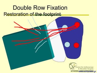 Double Row Fixation
Restoration of the footprint
www.shoulder.gr
 