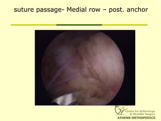 suture passage- Medial row – post. anchor
 