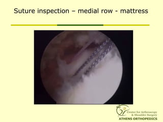 Suture inspection – medial row - mattress
 