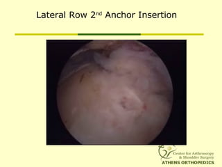 Lateral Row 2nd
Anchor Insertion
 