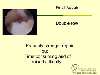 Final Repair
Double rowDouble row
Probably stronger repair
but
Time consuming and of
raised difficulty
 