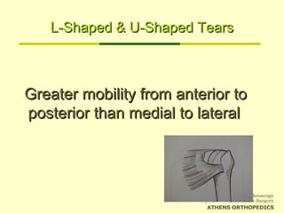L-Shaped & U-Shaped TearsL-Shaped & U-Shaped Tears
Greater mobility from anterior toGreater mobility from anterior to
posterior than medial to lateralposterior than medial to lateral
 