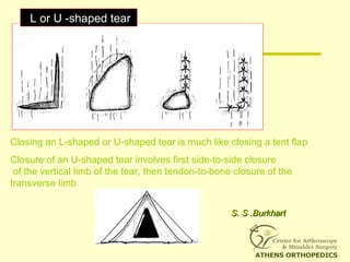 Closing an L-shaped or U-shaped tear is much like closing a tent flap
Closure of an U-shaped tear involves first side-to-side closure
of the vertical limb of the tear, then tendon-to-bone closure of the
transverse limb
L or U -shaped tear
S. S .BurkhartS. S .Burkhart
 
